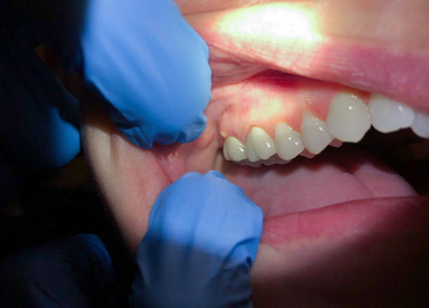 Best Broken or Cracked Tooth Emergency Dentist in Rancho Mirage, CA