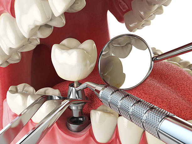 Best Emergency Dentist for Knocked-Out Tooth in Rancho Mirage, CA